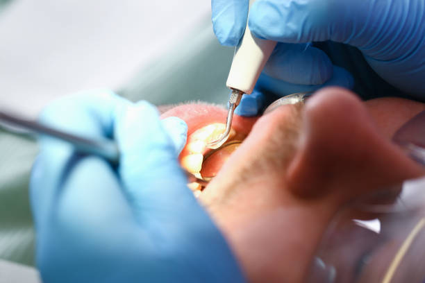 Best Chipped Tooth Repair Near Me  in Checotah, OK